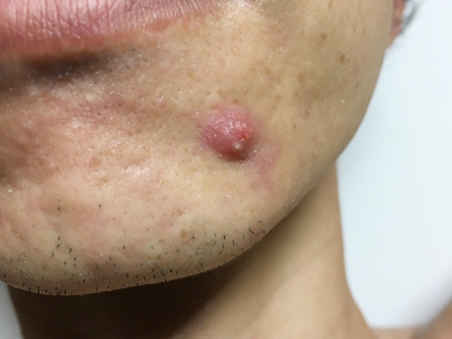 思春期ニキビと大人ニキビの違い